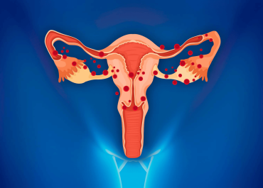 3 симптома эндометриоза и чем опасно заболевание